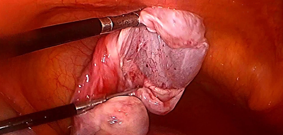 جراحی کیستها و تودههای تخمدان